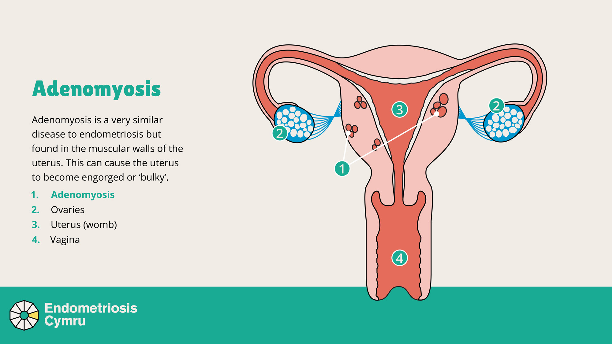 An image showing adenomyosis in the uterus