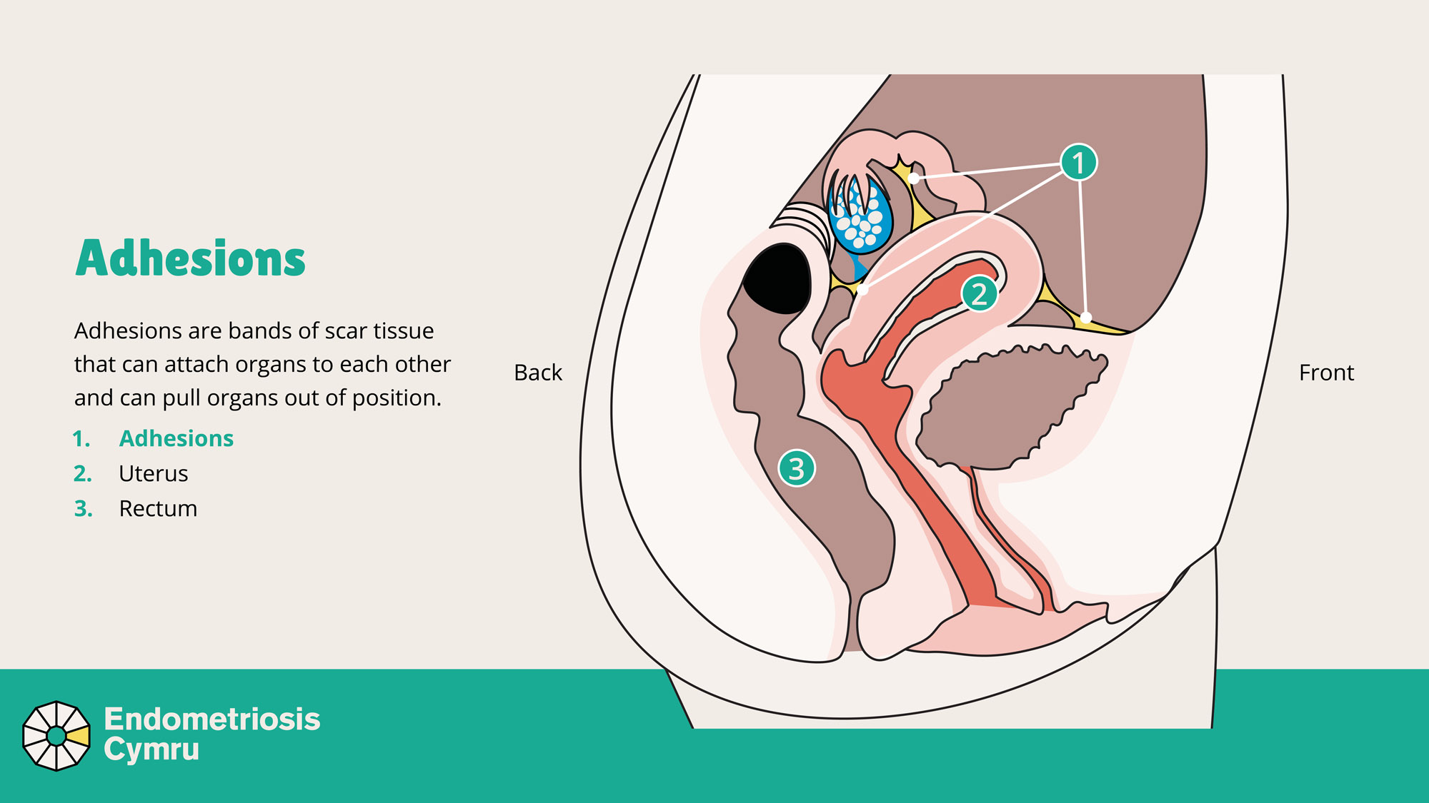 Diagram of the female pelvic area showing that adhesions can pull organs out of position