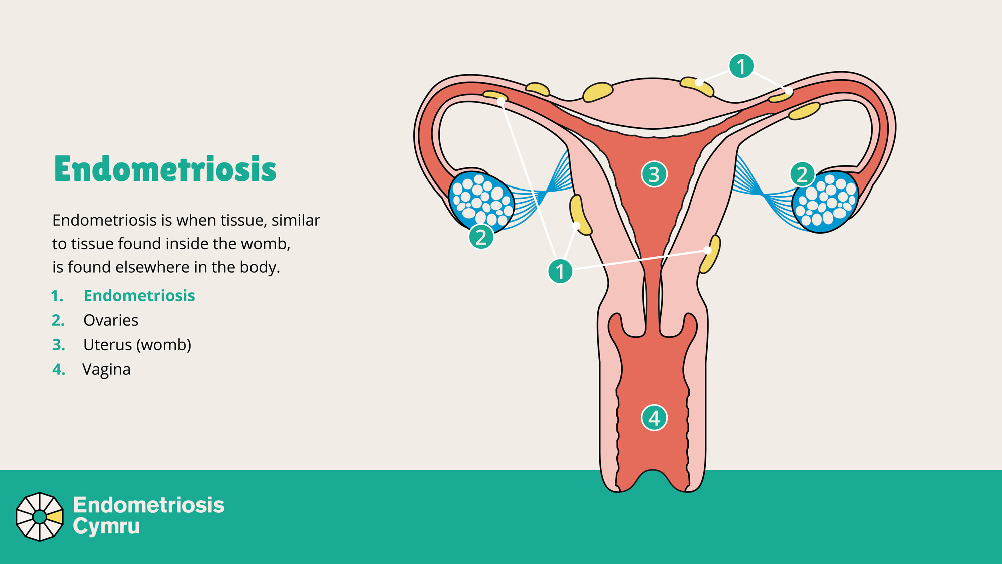 A diagram of the female reproductive organs showing spots of endometriosis tissue outside of the womb